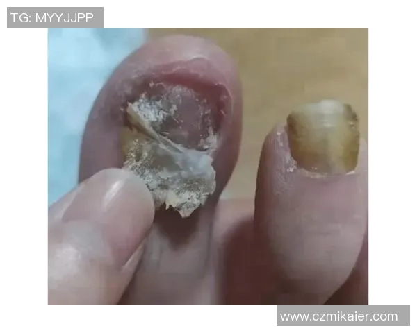 踢足球时如何预防和治疗灰指甲的有效方法与注意事项